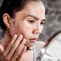 What is Melasma? – Dr. Pat